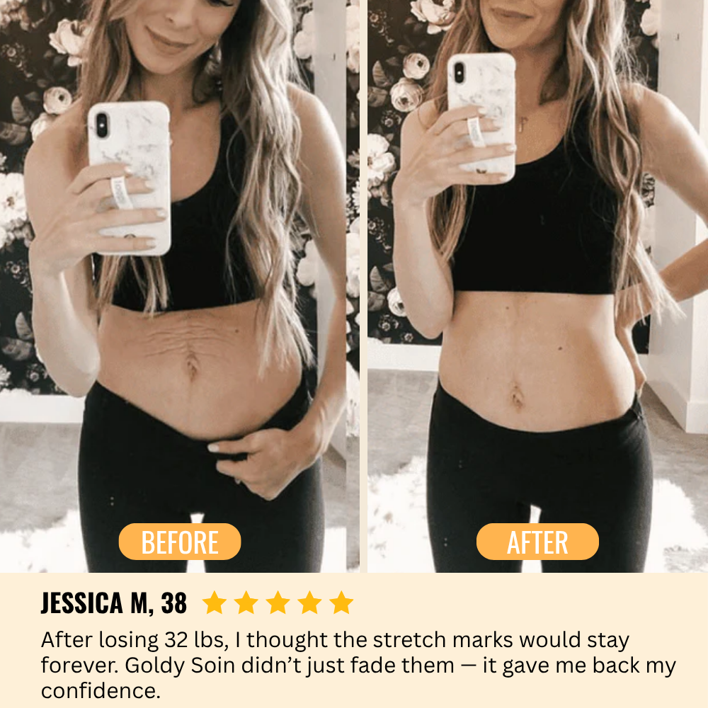 Stretch Mark & Scar Repair Cream