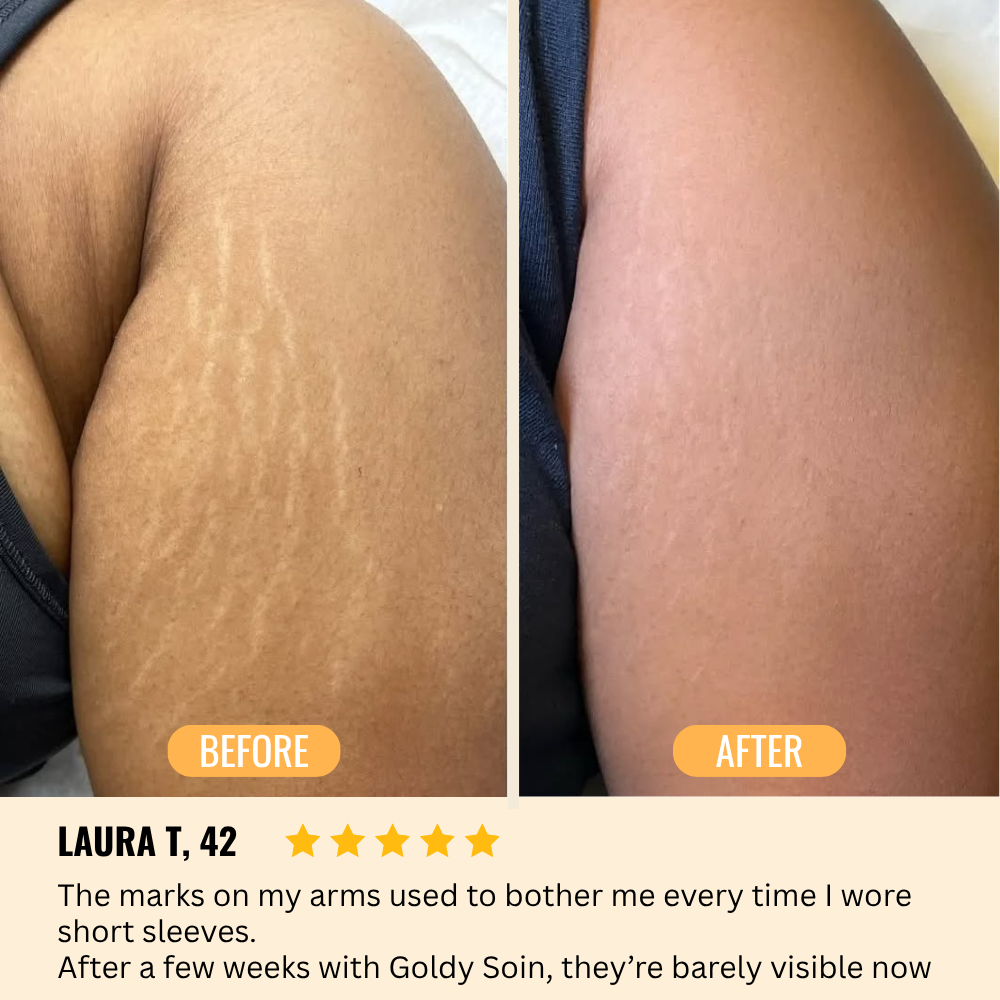 Stretch Mark & Scar Repair Cream
